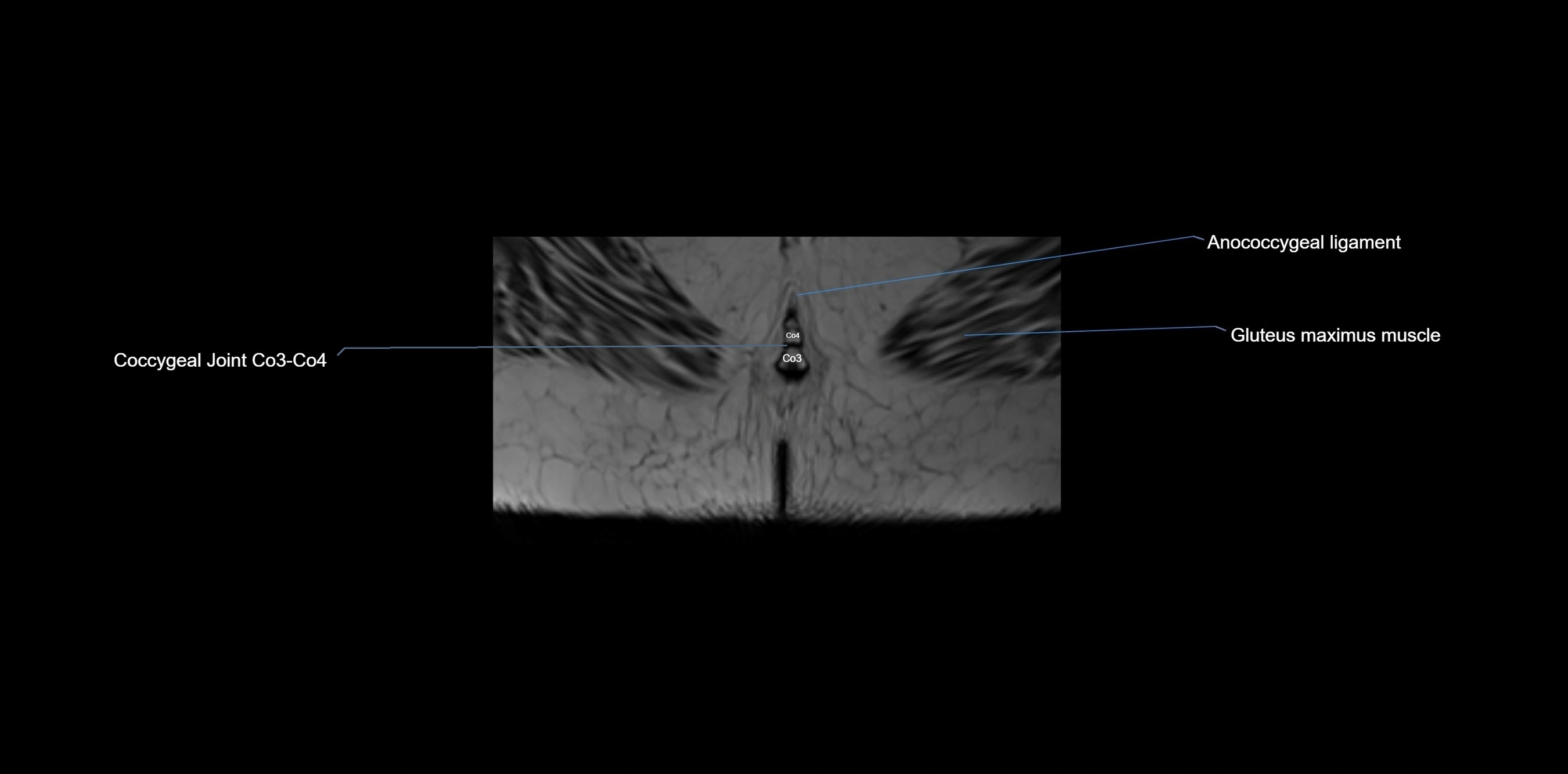 MRI sacrum, coccyx and sacroiliac joint axial cross sectional anatomy 3T  radiology  image-img-00001-00081.webp